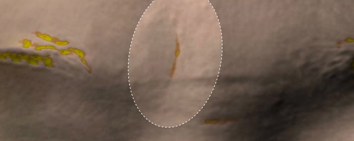 Skin Density — after