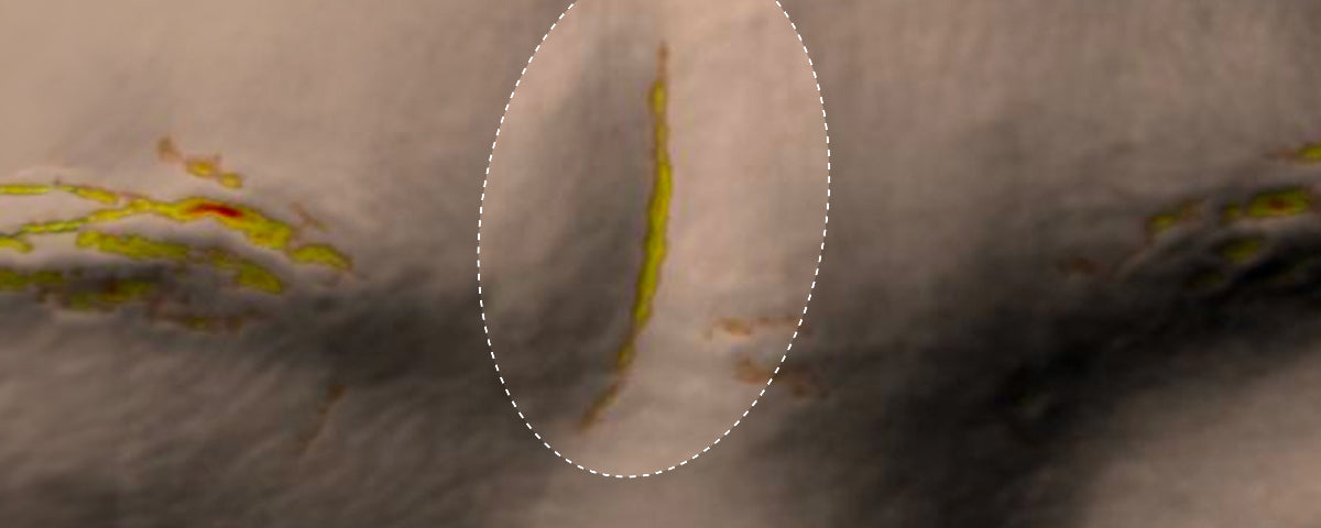 Skin Density — before